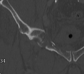 Acetabular Fracture Anterior Column